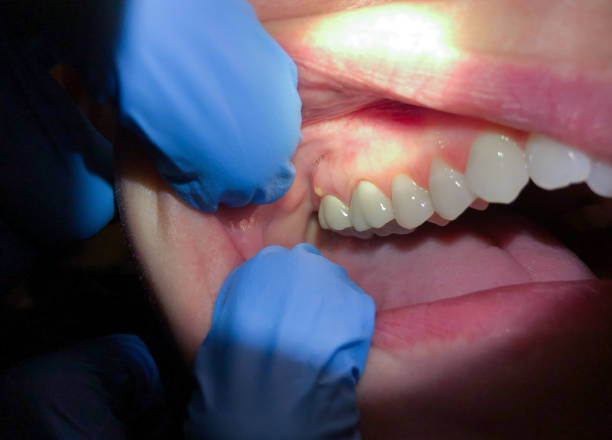 Best Emergency Treatment for Oral Infections in Ignacio, CO